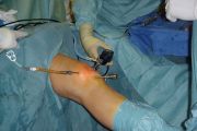 Reabilitação do joelho pós-sutura meniscal*