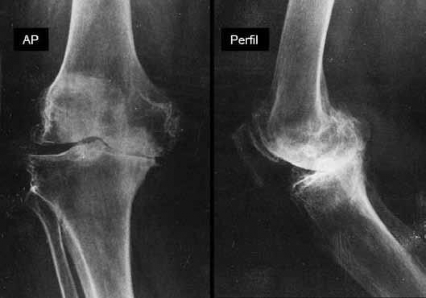 Estudo comparativo entre a classificação radiológica e análise macro e microscópica das lesões na osteoartrose do joelho