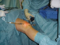 Reabilitação do joelho pós-sutura meniscal*